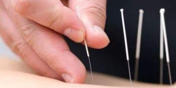 Some health conditions that Acupuncture may help treat