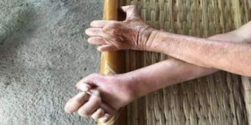 Leprosy - know about the complications | TheHealthSite.com